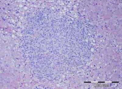 Slika 7. Jetra. Piogranulomatozni hepatitis i masna promjena hepatocita (HE x10)
